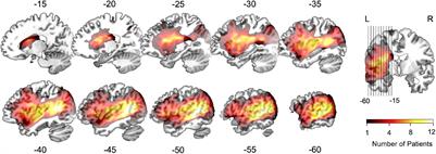 Altered Coupling Between Cerebral Blood Flow and Voxel-Mirrored Homotopic Connectivity Affects Stroke-Induced Speech Comprehension Deficits